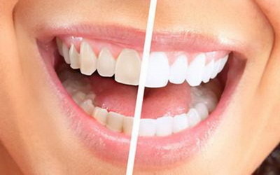 乳牙牙龈瘘管【乳牙牙龈发炎】
