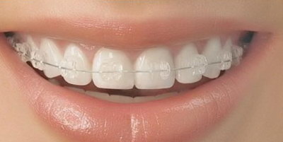 树脂补牙能维持多少年(什么是树脂补牙？)