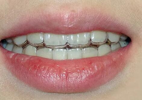 种植牙二期手术后牙龈覆盖牙