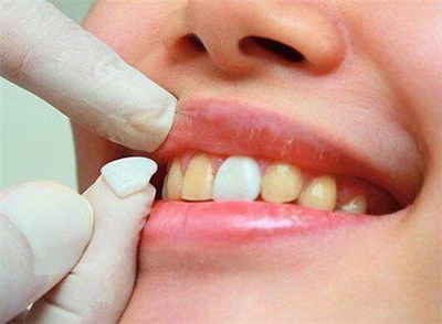 成人牙齿矫正有几种方法
