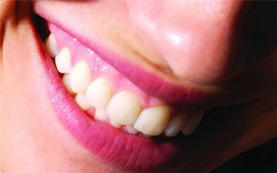 牙套什么年纪带最合适(深覆合的牙齿带什么类型的牙套最合适)