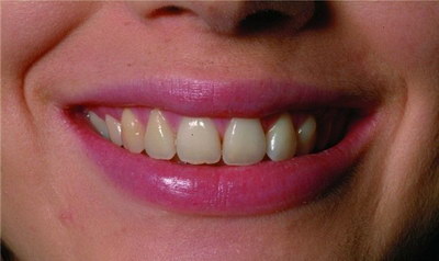 牙齿种植牙和打桩的区别
