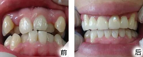 齿白金洗牙粉是否对牙齿有害