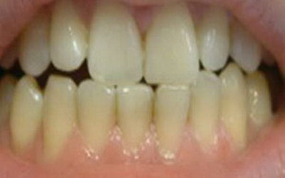 维c可以治疗牙龈出血(牙龈出血吃什么药可以治疗)