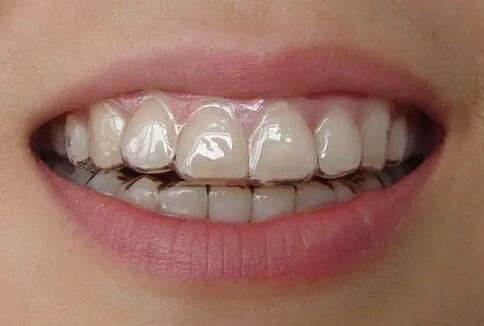 牙齿开裂戴牙套多少钱(牙齿开裂戴牙套)