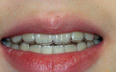 牙齿有黑线要补牙吗(牙齿黑线需要补牙吗)