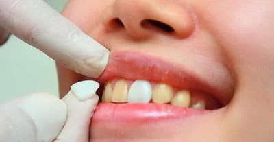 拔牙后牙床发肿多久能好「拔牙后牙床内侧面骨刺」