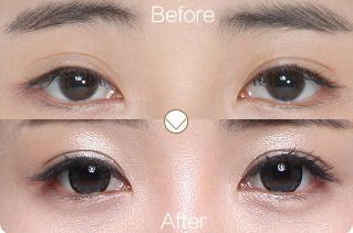 埋线法双眼皮手术法不切开皮肤