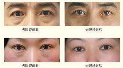 全切双眼皮疤痕增生期一般是多久【全切双眼皮疤痕增生不消水肿】