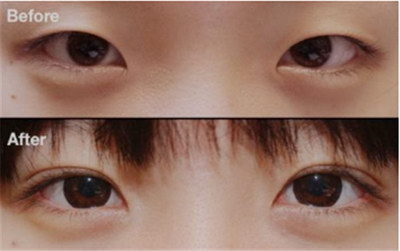 中国双眼皮修复医生(中国做双眼皮修复最权威的医生)