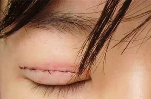 眼部整容的埋线双眼皮手术的疼痛感如何？