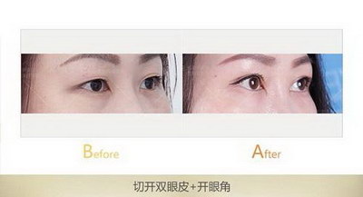 双眼皮修复术全过程(杭州双眼皮修复全过程)