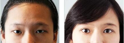 韩式三点双眼皮手术原理
