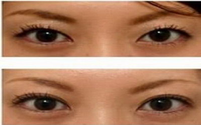 埋线双眼皮修复需要考虑的因素