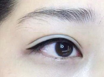 双眼皮手术多久可以带美瞳