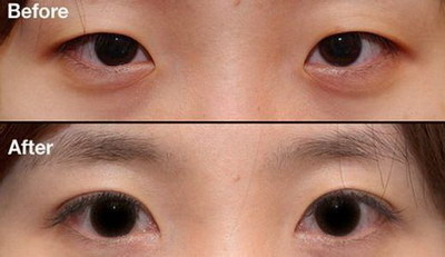 三点定位双眼皮恢复要多久(三点定位双眼皮恢复多久定型)