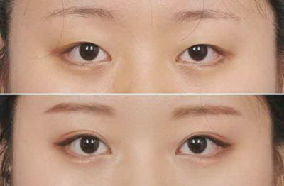 韩式双眼皮手术注意事项都有几点呢？