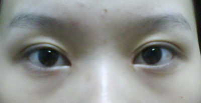 内眼角长斑是什么原因