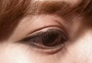 韩式三点双眼皮怎么修复