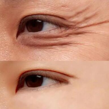 双眼皮一般几天能恢复正常