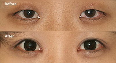 眼睑浮肿用什么穴位(儿童眼睑和眼袋浮肿是什么原因)