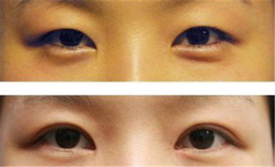 双眼皮术后很对称,恢复期不对称了【双眼皮术后恢复期反复肿胀】