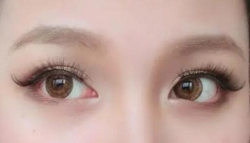 开眼角手术对眼睛有什么伤害