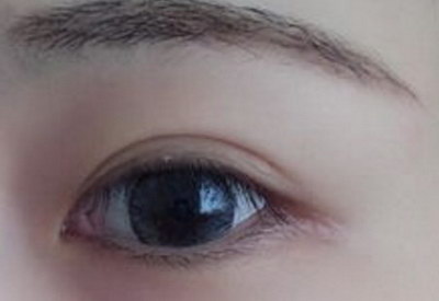 埋线双眼皮能维持几年后眼睛会变形吗