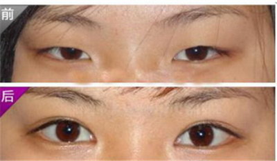 眼综合和割双眼皮有什么区别(眼综合与割双眼皮皮有什么区别)