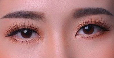 韩式三点式双眼皮的优点与缺点