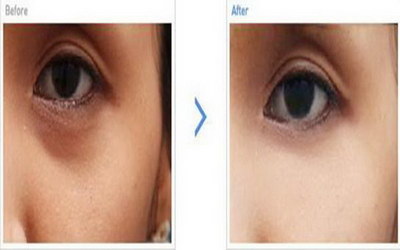 双眼皮手术如何护理清洁_埋线双眼皮手术如何护理
