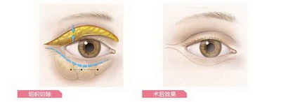 疤痕体质可以割双眼皮手术吗(疤痕体质可以做埋线双眼皮手术吗)