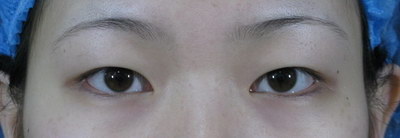 双眼皮一个月和两个月的变化(双眼皮一个月和两个月的差别)