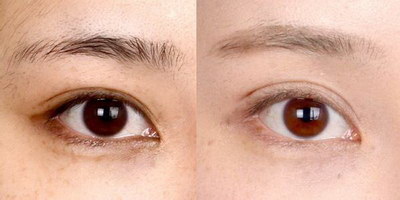 韩式做双眼皮手术该去哪家医院更好？