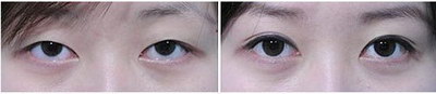 双眼皮的几种方式「双眼皮几种手术方式」