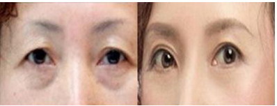 修复过5次双眼皮几年能恢复自然(双眼皮几年修复一次)