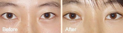 双眼皮手术增生可以用氯霉素滴眼液吗