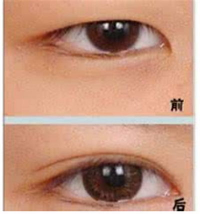 双眼皮修复的禁忌症有哪些?