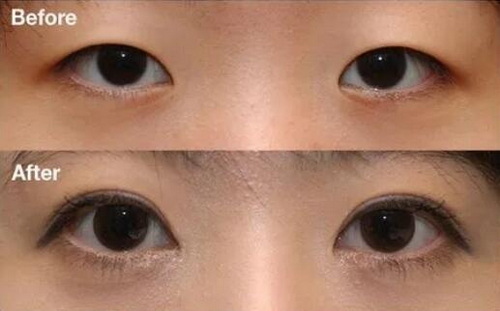 长期的黑眼圈怎么去除19岁(长期的黑眼圈怎么去除)