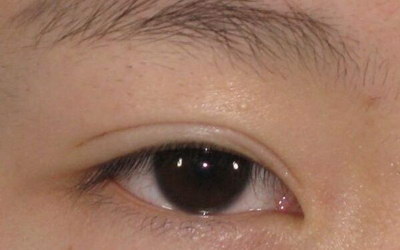 黑眼圈是什么病造成的(有黑眼圈是什么造成的)