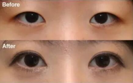 内双眼皮和单眼皮的区别(单眼皮双眼皮的区别)