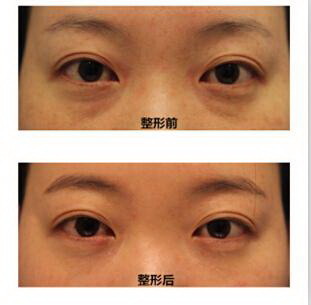 双眼皮手术后如何避免留疤