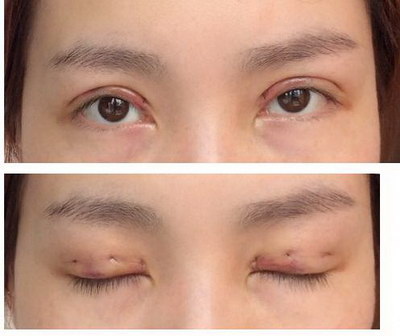 单眼皮能不能做开眼角手术呢？效果如何？