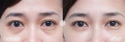 双眼皮手术后恢复期是多久？