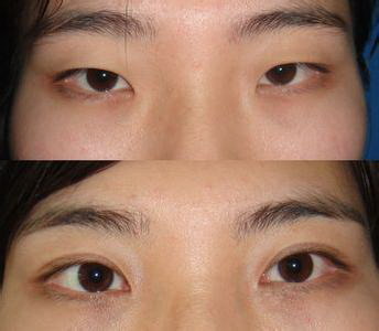 双眼皮修复：它是什么，有什么用？
