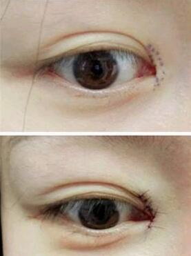 修复眼睛的医生「上海修复眼睛比较好的医生」