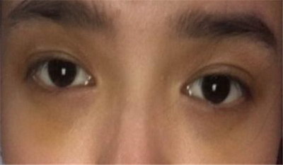 眼部卡粉是什么原因(眼部结节是什么原因)