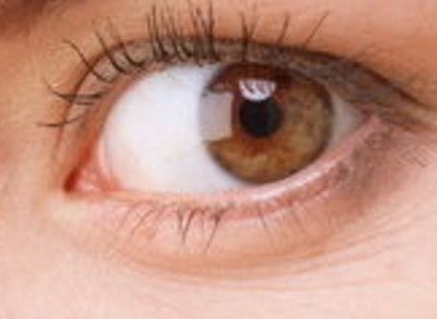 双眼皮显性遗传图片(什么是双眼皮显性遗传？)