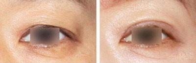 怎么样选择双眼皮手术方法？