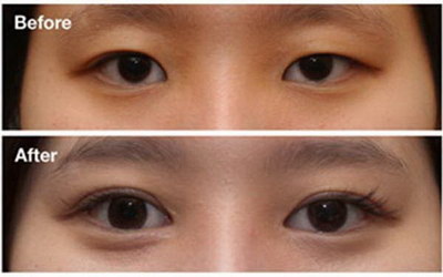 韩式开眼角手术有哪些优势
